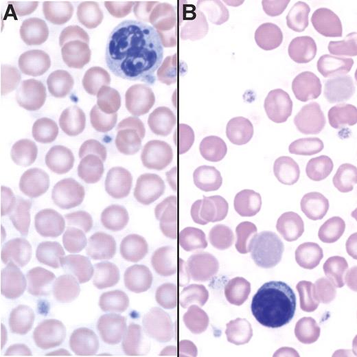Figure 2. Tg+ mice are anemic. (A) Peripheral blood smear of a Tg− mouse stained with Wright-Giemsa. (B) Peripheral blood smear of a Tg+ mouse stained with Wright-Giemsa showing hypochromia and the presence of target cells.