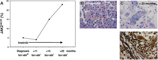 Figure 1. JAK2VG17F allele frequency and bone marrow histology. (A) The percentage of mutated JAK2 alleles increased from 5% (prior to imatinib therapy) to 23% (after 23 months of imatinib therapy), while the initial BCR-ABL e19a2 fusion transcript became undetectable after 11 months of treatment. The dotted line indicates the JAK2 wild-type status of 125 control volunteers (87 bone marrow biopsies from patients with Ph+ CML and peripheral blood from 38 healthy blood donors). For the Pyrosequencer assay (Biotage, Uppsala, Sweden), 25 ng of formalin-fixed and paraffin-embedded (FFPE) bone marrow biopsy–derived DNA was used to generate a 102-bp JAK2 polymerase chain reaction (PCR) product (JAK2 forward, 5′-TATGATGAGCAAGCTTTCTCACAAG-3′; JAK2 reverse, 5′-AGAAAGGCATTAGAAAGCCTGTAGTT-3′; GenBank accession no. AL161450) and a 130-bp MPL product (MPL forward, 5′-ATCTCCTTGGTGACCGCTCTG-3′; MPL reverse, 5′-TGGTCCACCGCCAGTCTG-3′; GenBank accession no. U68161). The Pyrosequencer detects the pyrophosphate release per wild-type G or mutated T incorporation at JAK2 position 1849 or at MPL position 1544, respectively, by a connected enzyme cascade with a luciferase-induced light signal. The light signal intensity is proportional to the amount of G or T and allows a quantification of the mutated T allele (positive/negative controls: JAK2 mutant cell line HEL, MPL mutated patient sample, and JAK2/MPL wild-type cell line HL-60). (B) Pretherapy bone marrow trephine revealed increased cellularity with a prominent promyelocytic proliferation and typical micromegakaryocytes (Giemsa stain; original magnification, ×1000). (C) Posttherapy bone marrow trephine showed predominant megakaryocytic proliferation with large and bizarre megakaryocytes arranged in clusters (Giemsa stain; original magnification, ×1000). (D) Megakaryocytic proliferation was associated with a marked increase of argyrophilic fibers (silver stain; original magnification, ×1000). Images in panels B-D were produced with a BX51 microscope equipped with a 40×/0.8 Vplan/Apo objective, a DP50 digital camera, and DP3.1 software, all from Olympus (Hamburg, Germany).