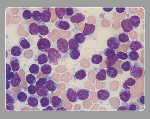 Peter Maslak, Memorial Sloan-Kettering Cancer Center . / Bone marrow aspirate with an increased number of lymphocytes. They appear mature with scant cytoplasm and condensed, clumped chromatin. Lymphocytes are friable, and some may become distorted or smudged in the process of spreading the spicule and making the slide.