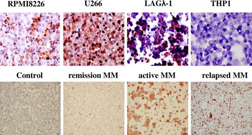 Figure 2. PTN protein is produced by myeloma cells. PTN protein expression was assessed in myeloma cell lines, the BMMCs from myeloma patients, and healthy donors by IHC. The myeloma cell lines RPMI 8226 and U266, and the human myeloma tumor LAGλ-1, expressed high levels of PTN protein. In contrast, the monocytic cell line THP-1 showed no PTN staining. BMMCs from a healthy donor (control) did not produce PTN. PTN was highly expressed in the BM from an MM patient with active disease and in a relapsing patient but not in an MM patient in remission.