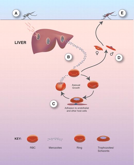 Figure 1. Plasmodia life cycle. (A) The asexual life cycle begins when sporozoites from a female mosquito taking a blood meal enter the circulation and invade hepatocytes. (B) Up to 10 000 merozoites are formed. Following rupture of the hepatocyte, infective merozoites are released and invade erythrocytes (RBCs). (C) Within RBCs, the parasite develops through the stages of rings, trophozoites, and schizonts. Mature schizonts burst to release erythrocytic merozoites that invade new RBCs. (D) A small proportion of merozoites in RBCs transform into male and female gametocytes that are ingested by the mosquito. (E) The male and female gametes fuse and transform into an öocyst that divides asexually into many sporozoites that migrate to the salivary glands from where they are released during the next blood meal. Reproduced from Ocana-Morgher et al13 with permission.