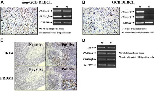 Figure 1. PRDM1 was expressed in lymphoma cells of non-GCB DLBCL and related to IRF4 expression. With different protein expression patterns revealed by immunohistochemisty (A-B), PRDM1 transcripts were expressed in microdissected lymphoma cells of DLBCL non-GCB subtype (A) but not of GCB subtype (B) (40×/0.75 NA non-oil objective). PRDM1 expression was related to IRF4 expression (C). IRF4-positive lymphoma cells coexpressed IRF4, PRDM1α, and PRDM1β (D) (10×/0.75 NA non-oil objective; small figure: 150×/0.75 NA non-oil objective).