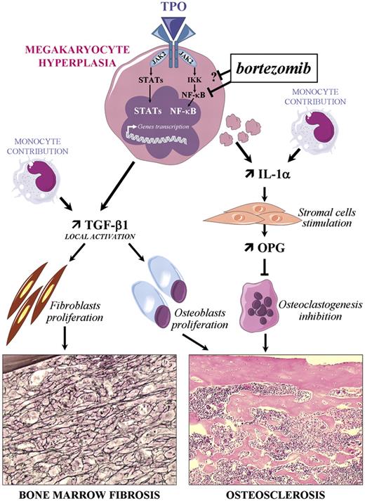 Figure 6. Pathogenesis model of stromal reaction in TPOhigh mice. TPO overexpression leads to megakaryocyte hyperplasia in hematopoietic tissues with dysmegakaryopoiesis and increases neutrophil emperipolesis, which induces, probably with the contribution of monocytes, an augmentation of the TGF-β1 release in extracellular fluids of bone marrow and spleen. The local activation of TGF-β1 is required within hematopoietic microenvironment for the fibroblast-mediated fibrosis development. Osteosclerosis development is related, on one hand, to osteoblast proliferation stimulated by TGF-β1 and, on the other hand, to the inhibition of osteoclastogenesis mediated by an increased secretion of stromal cell–derived OPG. IL-1α, released by hematopoietic cells, monocytes, and platelets, may be the cytokine responsible of this OPG up-regulation.