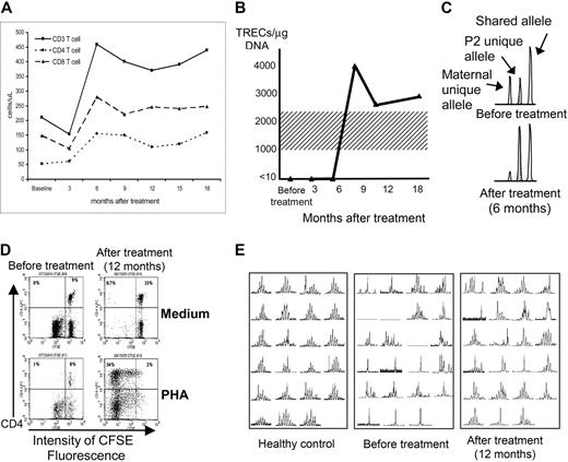 Figure 1. Improvements in immune function of patient P2 following gene therapy. (A) Increases in peripheral-blood CD4+, CD8+, and total CD3+ T-cell counts at 6 months after gene therapy. (B) TRECs, initially absent from peripheral-blood T cells, appearing at 9 months after gene therapy (normal adult range 1000-2200 TRECs/μg DNA, shading). (C) Shift in T-cell chimerism after gene therapy (area under PCR-amplified polymorphic allele peaks; Cofiler; Applied Biosystems, Foster City, CA), from before gene therapy (top set of peaks) where there is 51% maternal bone marrow donor (left peak) and 49% P2 host (stippled middle peak) to 6 months after gene therapy (bottom set of peaks) where the ratio is 13% donor versus 87% host. (D) CD4+ T-cell proliferation measured by decrease in fluorescence in response to PHA mitogen stimulation, absent before gene therapy (empty top left quadrant of the bottom left panel) but normal at 12 months after gene therapy (top left quadrant of the bottom right panel). P2 blood mononuclear leukocytes were labeled with the permanent cell-membrane–binding dye CFSE and cultured for 5 days in medium alone (control; top panels) or PHA (stimulus; bottom panels), then labeled with phycoerythrin-labeled anti-CD4 antibody. CD4+ T cells appear in the top half of each panel, and proliferation of the CD4+ T cells (dilution of CSFE fluorescence) is seen to occur only after gene therapy and only in response to PHA stimulation (bottom right panel). Not shown is that CD8+ T-cell response to PHA and both CD4+ and CD8+ responses to ConA, PWM, and Candida antigen increased similarly as measured by the CSFE assay. (E) Spectratyping of the Vβ TCR repertoire of CD3+ T cells23 from P2, demonstrating very restricted diversity before gene therapy (middle panel; total absence of representation of 3 Vβ families and almost monoclonal single-peak representation within 6 or 7 families) but increased diversity at 12 months after gene therapy (right panel; some representation in all the Vβ families, almost monoclonal single-peak representation only within 3 or 4 families, and clear improvement in multipeak polyclonality within 12 of the 23 families represented). A typical healthy control is shown in the left panel.