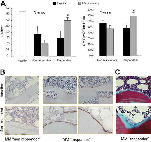 Figure 3. Effect of bortezomib on bone formation in MM patients. Histomorphometry and Runx2/Cbfa1 immunostaining performed on BM biopsies of 21 MM patients before and after 6 to 8 cycles of bortezomib in monotherapy according to the schedule described in the “Patients, materials, and methods.” The graphs and bars represent the mean plus SD of the number of osteoblasts (OBs)/mm2 and the percentage of Runx2/Cbfa1-positive OBs (A). Runx2/Cbfa1 immunostaining performed in a trabecula of 2 representative MM patients who responded or not to bortezomib treatment (original magnification, × 200; small insert, × 400) (B). Goldner trichrome–stained sections from a representative MM responder patient. (Microscope used was an Olympus B × 60 F5 equipped with a UPlan F: 100×/1.30 oil iris, WH10×/22. An Olympus DP10 digital microscope camera system was used for image acquisition (original magnification, × 200) (C).