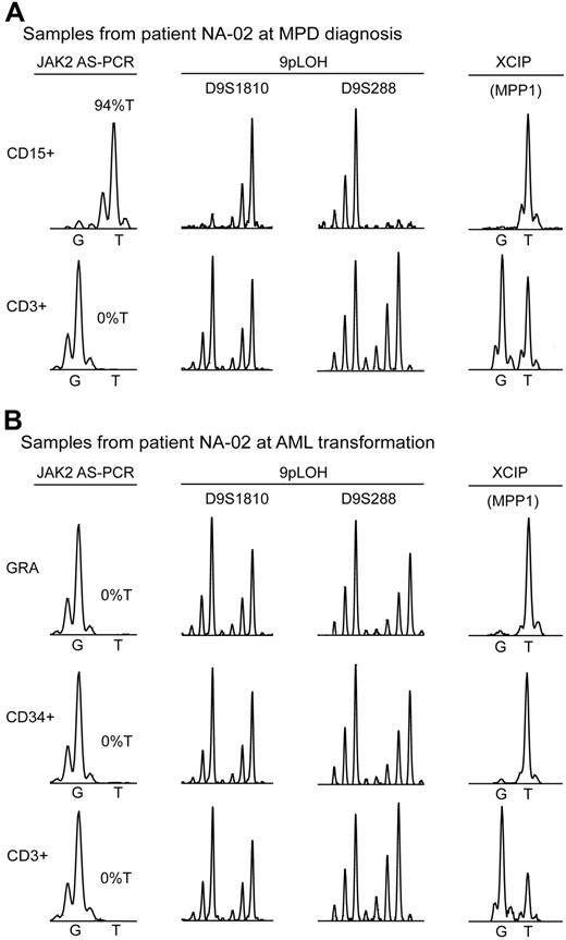 Figure 1. Analysis of clonal markers in patient NA-02. (A) Bone marrow samples at MPD diagnosis. The presence of the JAK2-V617F mutation was determined by AS-PCR using DNA from purified cells: CD15+, myeloid cells isolated by FACS; CD3+, T cells isolated by FACS. %T indicates the allelic ratio between the mutant and wild-type JAK2 allele. 9pLOH was determined with the microsatellite markers D9S1810 and D9S288 using DNA from purified cells as for JAK2. XCIP was determined by AS-PCR for a G/T polymorphism in the MPP1 mRNA. The relative expression of the 2 MPP1 alleles was determined by comparing the G and T peak intensities obtained by the allele-specific reverse transcription-PCR assay. (B) Peripheral blood samples at AML transformation. GRA, Granulocytes isolated by Ficoll density centrifugation; CD34+, leukemic blasts isolated by FACS; CD3+, T cells isolated by FACS. The assays were performed as in (A).