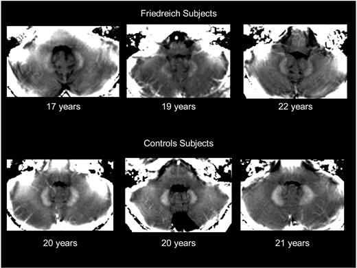Figure 1. MRI visualization of iron accumulation in dentate nuclei of 3 young patients with Friedreich ataxia and 3 healthy age-matched subjects. The figure shows a parametric image of R2* values in posterior fossa, derived from the multigradient echo sequence done at 1.5 T. Dentate nuclei with high R2* values appear whiter than surrounding cerebellum, smaller, and irregularly shaped in FA patients compared with control subjects. R2* values of the adjacent cerebellum have values in the order of 14 s−1, confirming good regional homogeneity of the magnetic field. The R2* values are given in the text. The above images are displayed following equal windowing and leveling of the R2* maps.