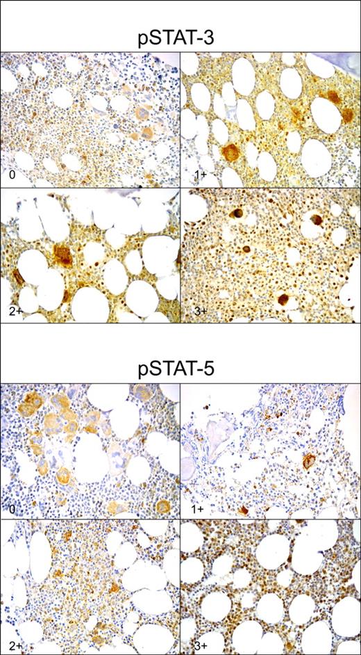 Figure 1. Staining intensity of phosphorylated STAT-3 and STAT-5 (pSTAT-3 and pSTAT-5, respectively). pSTAT-3 staining was scored 0 if fewer than 10 positive nuclei were present in high magnification field (400×); 1+ if 10 to 20 positive nuclei were present; 2+ if 21 to 40 positive nuclei were present; and 3+ if more than 40 positive nuclei were present. pSTAT-5 staining was scored 0 if 0 to 1 positive nucleus were present in high magnification field; 1+ if 2 to 4 positive nuclei were present; 2+ if 5 to 9 positive nuclei were present; and 3+ if more than 10 positive nuclei were found. For each slide, a minimum of 10 high-magnification fields were examined (avidin-biotin complex immunoperoxidase method: original magnification, 400×).