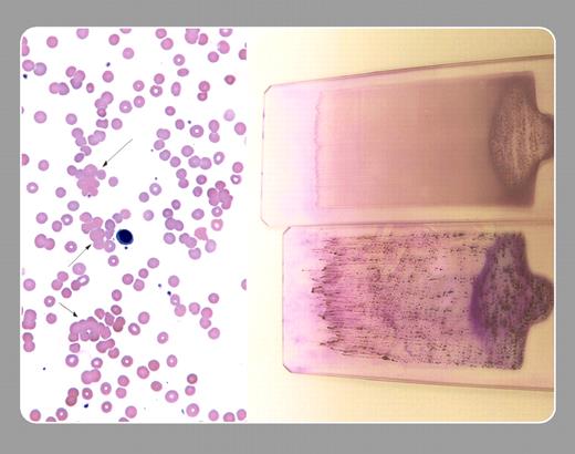 Neil Abramson, Baptist Cancer Institute