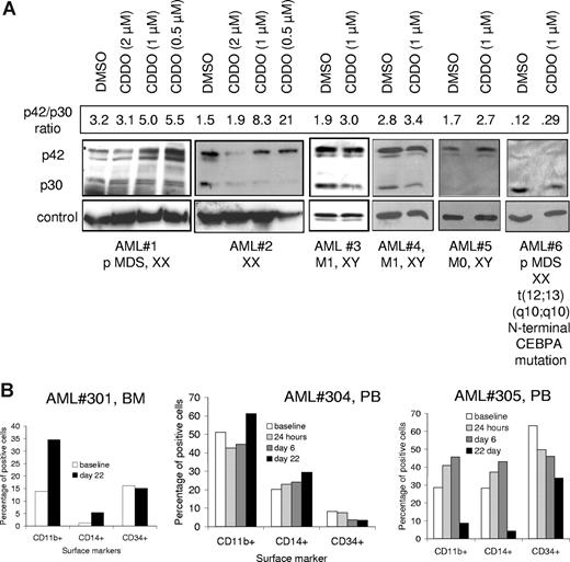 Figure 7. CDDO-mediated increase of active CEBPA protein and signs of differentiation in primary blasts from patients with AML. (A) AML blasts were cultured for 24 hours in the presence or absence of CDDO at different concentrations as indicated and subjected to Western blotting using an anti-CEBPA antibody. Anti–β-actin (AML nos. 1,2), anti-eIF2α (AML no. 3), or anti–beta-tubulin (AML nos. 4-6) antibodies were used for loading controls. Information about the type of AML and the karyotype and/or a CEBPA mutation are given below the blots. The densitometric units of p42/p30 are indicated as numbers above the Western blots. (B) Patients with refractory or relapsed AML were treated with CDDO (RTA401) during a phase 1 clinical trial, and cells were collected from the peripheral blood (PB) or bone marrow (BM) and assessed for expression of surface markers CD11b, CD14, and CD34 by flow cytometry at the indicated times (see also Table 2). Three of 5 patients (patients nos. 301, 304, 305) showed alterations of these parameters during the observed period. PB baseline percentages are not available from patient no. 301, therefore, BM percentages are provided.