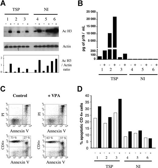 Figure 2. VPA induces hyperacetylation, triggers viral expression, and is proapoptotic for primary cells freshly isolated from HTLV-1–infected patients with tropical spastic paraparesis. (A) Histone H3 is hyperacetylated in the presence of VPA. Peripheral blood mononuclear cells were isolated from 3 HTLV-infected, untreated HAM/TSP patients (1-3) and 3 noninfected (NI) healthy controls (4-6) and directly cultivated (ie, without cryopreservation) for 48 hours in the absence (−) or the presence (+) of 2 mM VPA. Cell lysate protein (10 μg) was analyzed by Western blot using an antibody specific for the acetylated forms of histone H3 (Ac H3) or, as a control for normalization of the protein levels, an antiactin antiserum (actin). After incubation with the appropriate alkaline phosphatase–linked conjugates, the blots were revealed by chemiluminescence and autoradiography (top 2 panels). After quantification of the luminescence signals with a luminometer and subtraction of the background, a ratio between the mean intensities generated by each antibody was calculated (Ac H3/actin ratio). (B) VPA activates expression of the viral core protein p19 in the supernatant of these primary T-lymphocyte cultures. The culture supernatants in the absence (−) or the presence (+) of VPA were collected, and expression of the viral p19 core protein was quantified using a Zeptometrix ELISA. Absolute concentrations of p19 (in pg per mL) were determined by normalization of the absorbance values with a standard curve. (C) The CD4+ T lymphocytes undergo increased apoptosis in the presence of VPA compared with the controls. After culture, cells were labeled with a CD4-specific antibody conjugated to allophycocyanin (APC). Apoptotic cells were identified after staining with fluorescein-isothiocyanate (FITC)–labeled annexin V (annexin) and propidium iodide (PI). Ten thousand events per thrice-labeled sample were collected by flow cytometry and analyzed with the Cellquest software. The dot plots illustrate annexin/PI (upper panels) and CD4/annexin (bottom panels) labeling of cells isolated from a HAM/TSP patient and cultivated in the absence (control) or the presence (+VPA) of VPA. The percentages of CD4+ annexin− and CD4+ annexin+ are indicated in the upper quadrants. (D) The percentages of apoptotic CD4+ cells were measured in samples from the 3 HAM/TSP patients (1-3) and 3 noninfected controls (4-6) cultivated without (−) or with (+) 2 mM VPA. Note that all experiments illustrated in this figure were performed in parallel on freshly isolated noncryopreserved cells.