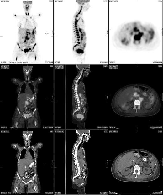 Figure 1. A pretreatment PET/CT scan in a 48-year-old female patient with Burkitt lymphoma showing widespread nodal and extranodal disease including periaortic, iliac, and mediastinal lymphadenopathy in addition to extensive involvement of the bone/bone marrow, both thyroid lobes and focal liver involvement.