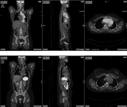 Figure 2. Pretherapy and posttherapy fused PET/CT images in a 17-year-old female patient with nodular sclerosis Hodgkin disease. The pretherapy images (top) showed bilateral supraclavicular, anterior mediastinal, and left hilar lymphadenopathy by both PET and CT. Posttherapy PET/CT performed 4 weeks following completion of 6 cycles of ABVD (doxorubicin, bleomycin, vinblastine, dacarbazine) showed resolution of disease in the supraclavicular and left hilar region but continued to show a residual 6.2 × 3.4-cm mass in the anterior mediastinum that was PET negative. Multiple biopsies of the mass showed only fibrous tissue with no evidence of lymphoma. The patient is currently without evidence of disease after 4 years of follow-up.