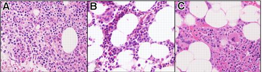 Figure 2. Bone marrow biopsy findings in a FIP1L1/PDGFRA-positive subject (subject 3). Before imatinib treatment (A), at 1 month following initiation of treatment (B), and at the time of molecular relapse (C). Posttreatment resolution of eosinophilia and hypercellularity was maintained despite molecular relapse. Sections were stained with hematoxylin and eosin (H&E), magnification 400×, and images were obtained by digital microscopy using an Olympus BH-Z microscope (Olympus America, Melville, NY) equipped with a DPlan 40 × 10.65 numeric aperture objective. Images were captured using an Olympus DP12 digital camera system and recorded on a 3.3V Smart Media (SSFDC) card. Imaging software was Adobe Photoshop version 6.0 (Adobe Systems, San Jose, CA).
