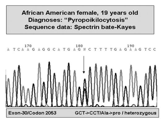 African American female, 19 years old Diagnoses: “Pyropoikilocytosis” Sequence data: Spectrin bate-Kayes