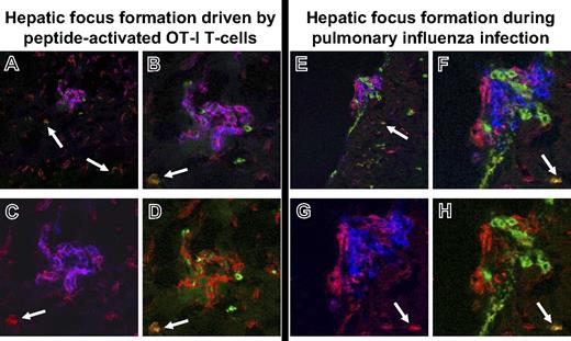 Figure 4. Only BM-derived KCs participate in focal intrahepatic inflammation. Liver sections of bone marrow transplant recipients were stained with CD45.2-FITC (green), CD45.1-Cy5 (displayed in false color blue), and F4/80-PE (red). Inflammatory foci developed during peptide-activated intrahepatic accumulation of adoptively transferred TCR-tg OT-I cells (A-D) or with accumulation of endogenous CD8+ T cells during pulmonary influenza infection (E-H). (A,E) In both models, sessile KCs (orange, closed arrow) were only detectable outside the foci. Kupffer cells within the foci are all BM derived (purple) with multiple BM-derived and recipient-type non-KC leukocytes within the foci (blue and green). Original magnification, ×200. (B,F) Enlarged (×400) inflammatory focus following adoptive OT-I transfer and peptide activation (B) or during pulmonary influenza infection (F). (C,D,G,H) Two-color reproductions of the same foci with F4/80-CD45.1 costaining for BM-derived KCs (C,G) and F4/80-CD45.2 costaining for sessile KCs (D,H) confirmed the absence of sessile KCs within inflammatory foci.