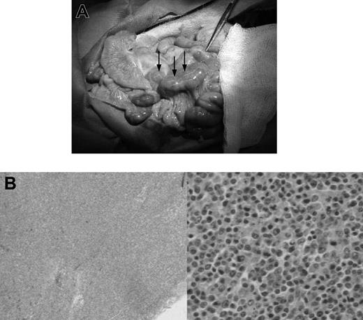 Figure 1. Gross pathologic and histologic findings of lymphoma (PTLD) in miniature swine. (A) Animals that developed lymphomas or PTLD typically had pronounced lymphadenopathy, as represented by animal 17018. Image was acquired using a Kodak camera (Eastman Kodak, Rochester, NY) model Easyshare Z740 with a 45.5-mm to 55-mm lens adapter. No further image processing was done. (B) Lymph node tissue harvested from these animals demonstrated destruction of normal architecture and predominance of abnormal cells as represented by animal 13271. Slides were viewed with an Olympus BX51 compound microscope (Olympus America, Melville, NY) of sections stained with hematoxylin and eosin (H&E; Hematoxylin Gill's Formulation no. 2, Fisher Diagnostics, Fair Lawn, NJ; Eosin-Y, Richard-Allan Scientific, Kalamazoo, MI) using a lens at 40× (left) and 400× (right). Images were acquired using an Olympus digital microscope camera (Olympus America) model Q-Color 3, and were processed with Adobe Photoshop CS version 8 software (Adobe Systems, San Jose, CA).