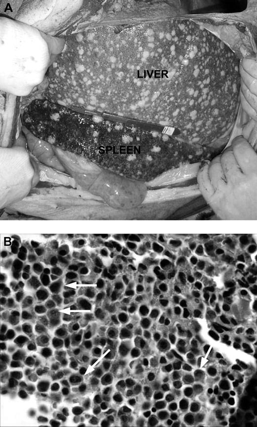Figure 2. Gross pathologic and histologic findings of leukemia in miniature swine. (A) The most consistent findings of animals with leukemias were enlarged liver and spleen, which on palpation were firm and pale in color with visible lesions, as shown by animal 15549. Image was acquired using a Kodak camera (Eastman Kodak) model Easyshare Z740 with a 45.5-mm to 55-mm lens adapter. No further image processing was done. (B) Bone marrow from these animals was predominantly populated with abnormal cells, as represented by tissue from animal 14736. Slide was viewed with an Olympus BX51 compound microscope (Olympus America) of sections stained with H&E (Hematoxylin Gill's Formulation no. 2, Fisher Diagnostics; Eosin-Y, Richard-Allan Scientific) using a lens at 400×. Image was acquired using an Olympus digital microscope camera (Olympus America) model Q-Color 3, and was processed with Adobe Photoshop CS version 8 software (Adobe Systems).