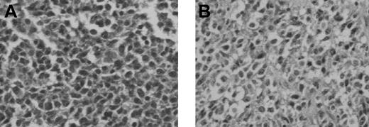 Figure 4. Histologic findings after in vivo transfer of LCL-13271 tumor cells in NOD/SCID mice. LCL-13271 injected intraperitoneally into NOD/SCID mice with tumor growth at 2 months in primary and secondary recipients. Abdominal tumor mass from NOD/SCID primary (A) and secondary (B) recipients of LCL-13271. Histologic findings were similar in morphology compared with the primary tumor (Huang et al35). Slides were viewed with an Olympus BX40 microscope (Olympus America) of sections stained with H&E medium (Hematoxylin Gill's Formulation no. 2, Fisher Diagnostics; Eosin-Y, Richard-Allan Scientific) using a lens at 400×. Images were acquired using a Hitachi charge-coupled device color camera (Hitachi Kokusai Electric America, Woodbury, NY) model HV-C20 3-CCD, and were processed with ACDSee version 4.0 software (ACD Systems International, Victoria, BC).