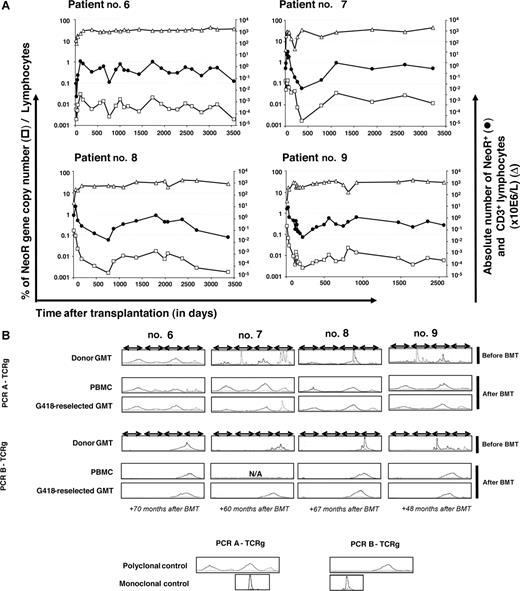 Figure 2. Monitoring of NeoR+ persistently circulating GMCs. (A) Kinetics of persistently circulating NeoR+ GMCs in 4 patients with a follow-up of more than 10 years. △ and ● indicate the absolute number of lymphocytes and GMCs, respectively (right y-axis); □ indicates the percentage of GMCs among circulating lymphocytes (assuming that there is one transgene copy of per cell) (left y-axis). The last analysis date was day 3557 (118.5 months), 3228 (118.5 months), 3379 (112.6 months), and 2063 (68.76 months) for patients 6, 7, 8, and 9, respectively. (B) Absence of T-cell clonality. Clonality was determined by PCR analysis of TCRγ gene rearrangements within donor GMCs before infusion, within PBMCs, and within GMCs G418-reselected at different time points after BMT, using 2 Vγ-Jγ PCR mixes (PCR A-TCRg: V γ 1f + V γ 10 − J γ 1.1/2.1 + J γ 1.3/2.3; PCR B-TCRg: V γ 9 + V γ 11 − J γ 1.1/2.1 + J γ 1.3/2.3). Both PCRs used consensus-specific primers from Vγ families, allowing coverage of most of the TCRγ rearrangements (sensitivity, 10−2 to 10−3). The Gaussian profile confirms the absence of detectable clonal expansion. Multiple peaks without Gaussian distribution were in favor of an oligoclonal T-cell population. Polyclonal and monoclonal controls were DNA extracted from tonsil and Jurkat cell lines, respectively. N/A indicates not analyzable.
