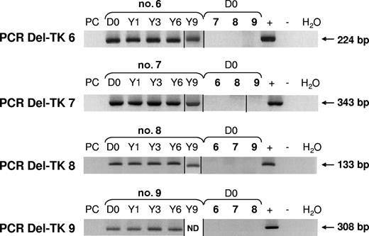 Figure 7. Deletions occurred during the ex vivo production of GMCs. Using nested PCR assays with a second run using a specific primer spanning the junction sequence, no deletions within packaging cell line DNA (PC) were detected. PCR products were detected within GMC products before infusion (D0), as well as 1, 3, 6, and 9 years (Y) after infusion. Specific PCR was applied to GMC samples of the 4 patients, enabling demonstration that deletions were patient specific. ND indicates not done. Vertical lines have been inserted to indicate a repositioned gel lane.