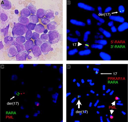 Figure 1. Morphology and metaphase FISH assays on bone marrow of the variant APL. (A) Bone marrow morphology showing hypergranular promyelocytes lacking Auer rods. Image of May-Grünwald-Giemsa–stained smear was acquired using an Olympus BX-40 microscope (Olympus, Tokyo, Japan) equipped with a 100×/1.3 NA oil objective and a mounted DP12 digital camera (Olympus). (B) The LSI RARA dual-color break-apart rearrangement probe (Vysis, Downers Grove, IL) resulted in a normal fusion signal on one chromosome 17 and a small green signal close to the q terminal region of der(17) with deletion of the proximal red signal. (C) FISH with the LSI PML-RARA dual-color dual-fusion translocation probe (Vysis) resulted in normal red PML signals, one normal green RARA signal (not shown), and one split RARA signal. (D) A PRKAR1A probe (BAC RP11–120M18), labeled with Spectrum Orange (Vysis), combined with LSI PML-RARA dual-fusion translocation probe (as in panel C) confirmed that the fusion gene expressed by the patient was the result of a complex chromosome rearrangement which disrupted both the RARA gene on 17q21 and PRKAR1A on 17q24; the normal chromosome 17 has a single green signal (RARA) and a distal red signal (PRKAR1A), whereas the der(17) has a split green signal (RARA) where the more distal green signal colocalizes with a weaker red signal (PRKAR1A), indicating deletion of part of the probe. Note that the strong red PML probe signals on the 2 chromosomes 15 are because of image enhancement that was necessary to visualize the weak signals on the der(17). All FISH was performed according to manufacturer's instructions, and chromosomes were counterstained with DAPI (Sigma, St Louis, MO). Analysis was undertaken using a Zeiss Axioskop fluorescence microscope (Zeiss, Oberkochen, Germany) equipped with a 100× /1.3 NA oil objective. Images captured using the Isis image analysis system (MetaSystems, Altlussheim, Germany) were processed with FISH imaging system version 5.2 software (MetaSystems).