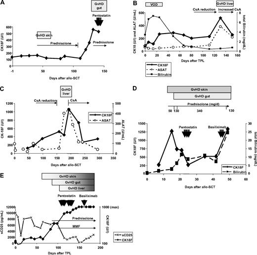 Figure 1. Time course of GVHD and CK18F levels in representative patients. (A) Patient UPN 211: slight increase of basal CK18F levels (132 U/L) during acute GVHD I of the skin (day 40, 162 U/L) responding to steroid treatment. CK18F started to rise immediately after steroid reduction and at least 1 week prior to the onset of clinical symptoms of GVHD grade III of the gut. Steroid resistance of the latter episode was reflected by constantly high levels of CK18F after 7 days of high-dose prednisolone treatment. (B) Patient UPN 297: an episode of veno-occlusive disease (VOD) with high serum bilirubin levels following SCT did not coincide with increases in CK18F levels. Liver GVHD developed during reduction of CsA after day 100, which was accompanied by a brisk CK18F increase. This episode of GVHD immediately responded to the restoration of high CsA levels. (C) Patient UPN 275 developed chronic GVHD (liver and wasting syndrome) after CsA reduction. CK18F levels started to rise early after beginning of CsA tapering, whereas liver enzymes became elevated only 50 days thereafter. This episode of GVHD rapidly responded to renewed CsA treatment as shown by normalization of both CK18F and ALAT levels. (D) Patient UPN 301 developed acute GVHD grade IV of skin, liver, and gut as early as 10 days following SCT. Despite high-dose steroid treatment, GVHD progressed and bilirubin levels rose to 10 mg/dL, requiring second-line immunosuppressive treatment (pentostatin). CK18F fell below 300 U/L following steroid and penostatin therapy, which indicated reduced epithelial apoptotic activity and thereby response to treatment. However, this response was not noticed clinically, as the skin rash, diarrhea, and hyperbilirubinemia went unresolved. Therefore, therapy was switched to anti-CD25 (basiliximab), which could not prevent subsequent deterioration (fatal progress of GVHD in all 3 organs). (E) Patient UPN 363 developed GVHD of the skin around day 60. Intestinal symptoms started after day 90 and bilirubin levels rose after day 100. GVHD grade IV of the gut was histologically confirmed. Prednisolone was started on day 90; however, the GVHD progressed and salvage therapies were given. The patient did not respond to any of these treatments and subsequently died. This lack of clinical response was reflected by persistently high levels of CK18F. Note the reduction in sCD25 levels following steroid treatment.