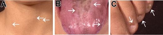 Figure 2. Clinical presentation in family A. Photographs of index case of family A with a homozygous R811C TERT mutation showing (A) reticulate skin pigmentation, (B) leukoplakia of tongue, and (C) nail dystrophy. Significant areas are highlighted by white arrows.