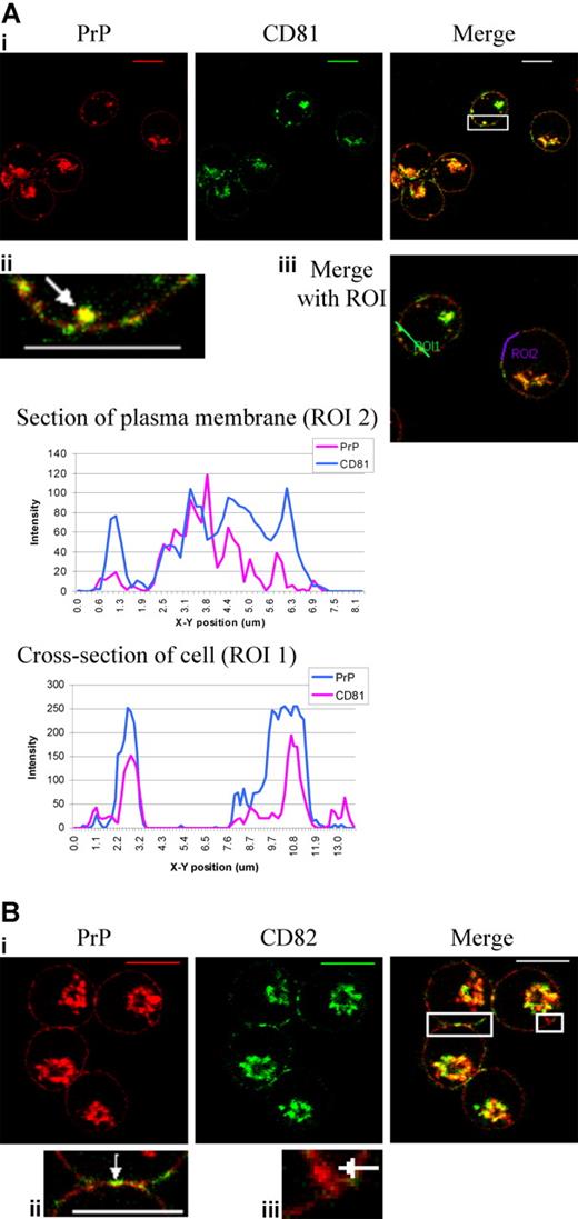 Figure 3. PrPc colocalizes with tetraspanins CD81 and CD82 at the plasma membrane. (Ai) Fixed and permeabilized day-6 erythroblasts were dual stained with PrPc mAb (red) and CD81 mAb (green). Overlays were prepared and the highlighted area magnified to show (Aii) an internal colocalized vesicle (arrow) and the plasma membrane. (Aiii) ROIs were drawn through a cell (ROI1) and along the cell surface (ROI2), and profiles of green and red fluorescence along these ROIs were constructed using Leica quantiation software. Scale bars equal 10μm. (Bi) Fixed and permeabilized day-6 erythroblasts were dual stained with PrPc mAb (red) and CD82 mAb (green). Overlays were prepared and highlighted areas magnified to show (Bii) plasma membrane at cell-cell contact site and (Biii) internal PrP-containing vesicle (arrow). Scale bars equal 10 μm.