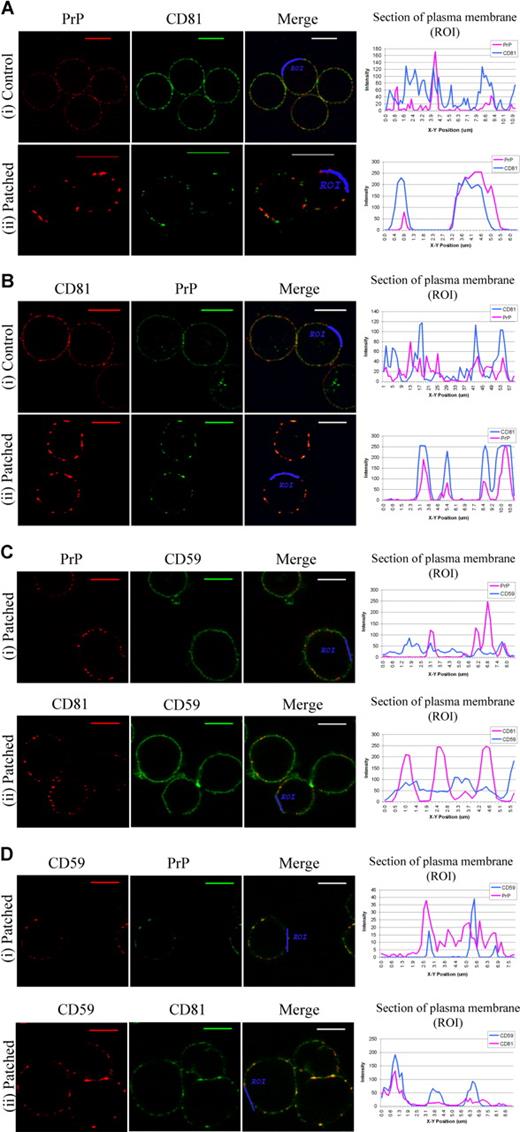 Figure 4. Patching experiments suggest CD81 and PrPc can share the same microdomain. ROIs were drawn along the cell surface of each merge image, and profiles of green and red fluorescence along these ROI were constructed using Leica quantiation software. (Ai) Control cells were fixed then stained for PrP (red) and CD81 (green). (Aii) Cells underwent PrP antibody–induced patching (red) then fixed and dual stained for CD81 (green). Scale bars equal 10 μm. (Bi) Control cells were fixed then stained for CD81 (red) and PrP (green). (Bii) Cells underwent CD81 antibody-induced patching (red), then were fixed and dual stained for PrP (green). (Ci) Cells underwent PrP antibody–induced patching (red), then were fixed and dual stained for CD59 (green). (Cii) Cells underwent CD81 antibody–induced patching (red), then were fixed and then dual stained for CD59 (green). (Di) Cells underwent CD59 antibody–induced patching (red), then were fixed and dual stained for PrP (green). (Dii) Cells underwent CD59 antibody–induced patching (red), then were fixed and dual stained for CD81 (green).