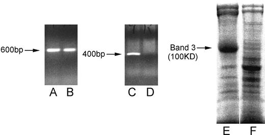 Figure 1. Lack of Band 3 expression in AE−/− gene-disrupted NZB mice. Lanes A-D illustrate ethidium bromide staining of agarose gel–fractionated PCR products corresponding to the disrupted (A,B, 600 base pairs) or wild-type (C,D, 400 base pairs) AE1 gene sequence using samples of genomic DNA from heterozygous AE+/− (A,C) or homozygous (B,D) AE−/− NZB mice. Lanes E and F illustrate SDS-PAGE analysis of wild-type (E) or AE−/− (F) murine RBC membrane preparations stained for protein with Coomassie Blue. Each track was loaded with approximately 20 μg protein. The position of Band 3, with an apparent molecular mass of 100 kDa, is indicated (→).