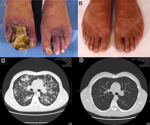 Figure 1. Photographs of the feet and computed tomographs of the chest of a patient treated with IL-12 and liposomal doxorubicin. Images in panels A and C were taken at baseline; those in panels B and D were taken at 22 months of treatment, the time of complete response. This patient was docu-mented to have a partial response at 4 weeks. Panels A and B were taken by NIH Patient Photographic Services using Nikon Digital SLR cameras (D1 and D1X respectively). Computed tomography scans were acquired from the NIH Clinical Center Diagnostic Radiology Department using the Kodak Carestream PACS web-based program. Images were imported into Adobe Photoshop v7 (Adobe Systems, San Jose, CA) for cropping and labelling. The images were then converted into a single Microsoft JPEG using MS Word 2003 (Microsoft, Seattle, WA) for importing into the manuscript as a single picture.