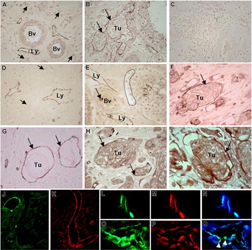 Figure 1. CEACAM1 expression in endothelial cells of tumor-associated lymphatics. (A) Lymphatics (Ly) in surrounding tumor cell–free area of testicular seminoma exhibit CEACAM1 immunostaining, while middle-sized (Bv) and small (→) blood vessels remain negative. (B) Lymphatics (→) containing clusters of seminoma (Tu) are positive for CEACAM1. (C) No immunostaining could be detected in control sections of testicular tumor tissue. (D) Similarly, in prostate carcinoma, lymphatics (Ly) of tumor-surrounding area, far from tumor area, express CEACAM1. (E) Endothelia of lymphatics (Ly) in close approximation to carcinoma-in-situ cells (…) in a seminiferous tubule exhibit CEACAM1 immunostaining, while neighboring blood vessels (Bv) are negative for CEACAM1 at this phase of tumor development. (F) Granulocytes (→) within the blood vessel lumen are stained as expected. In the invasive bladder cancer, CEACAM1 immunostaining is visible in endothelia of lymphatics (→) containing tumor cell groups (Tu) similar to testicular seminoma in panel B. Similar cells are positive for CD34 (→), indicating their endothelial origin (G); they also exhibit VEGFR-3 (Flt-4; →; H). (I) Double-immunostaining using CEACAM1 antibody 4D1/C2 and VEGFR-3 antibody demonstrates the co-localization of both (→), suggesting the lymphatic character of these cells. Sections in panels A-I are counterstained with calcium red. Immunofluorescence staining for CEACAM1 in a healthy area of human prostate demonstrates the expected localization in the healthy epithelium (J), while neighboring large and small lymphatics from the same area, which are marked by staining for podoplanin (K), do not exhibit CEACAM1. Double-immunofluorescence staining for CEACAM1 and podoplanin in prostate cancer tissue shows clear staining for CEACAM1 (L) and for podoplanin (M) in the same lymphatic vessels, as it is also confirmed by overlay (N). In a further tumor-associated lymphatic vessel, both CEACAM1 (O) and podoplanin (P) are present, but remarkably, single endothelial cells () integrated into the lymphatic endothelium exhibit only CEACAM1 (green fluorescence staining; Q).