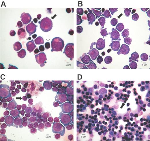 Figure 2. Cytospin preparations representing morphology of erythroid cells at different stages of the culture. The percentages of erythroid cells at each stage of differentiation were determined microscopically after May-Grünwald-Giemsa (MGG)–stained cytospins. Images were captured with an Olympus BX40 microscope, 40×/0.95 numerical aperture lens, fitted with Olympus Camedia C-3040ZOOM camera, and processed with Adobe Photoshop (Adobe Systems, Mountain View, CA). (A) Proerythroblasts (40%, ) are present on day 5, although lymphocytes () are the most abundant cell type. (B) Basophilic normoblasts (50%, ) are discernible on day 8. (C) Day 11 preparation demonstrates polychromatic erythroblasts (65%, ). (D) Day 15 culture shows late erythroblasts with pycnotic and shrunken nuclei (95%, ).