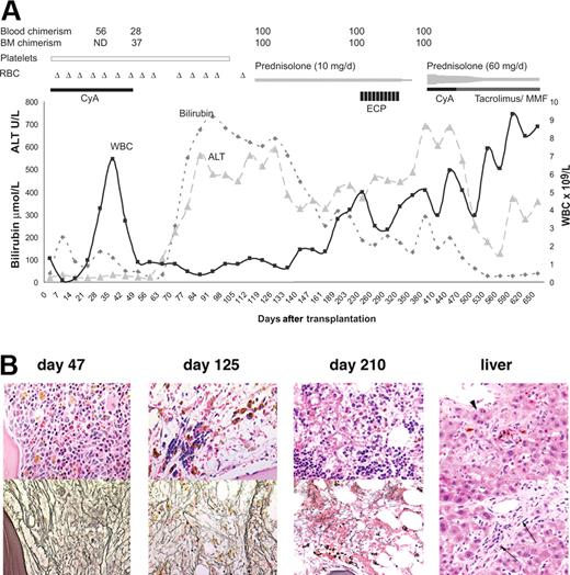 Figure 1. Clinical and histologic analysis of recovery after transplantation. (A) Recovery after transplantation. Blood chimerism and bone marrow (BM) chimerism are percentages; (▵) indicates days on which the patient received red blood cells (RBC). The open, black, and grey bars indicate administration of platelets, CyA, ECP, prednisolone, tacrolimus, and MMF. (B) Hematoxylin and eosin (top) and silver stain for reticulin (bottom) on bone marrow biopsies 47, 125, and 210 days after transplantation; liver biopsy on day 210 showing biliary metaplasia () and portal tract fibrosis (←). Images were acquired using a Nikon microscope (Nikon, Melville, NY) equipped with a 40×/.75 NA objective, a Spot color camera, and imaging software version 4.0.1 (Diagnostic Instruments, Sterling Heights, MI).