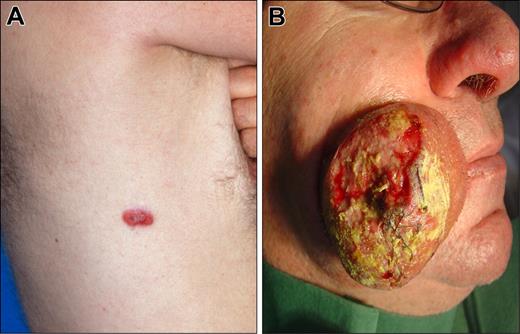 Figure 2. Clinical examples of proposed T1 (discrete solitary lesion) category of primary cutaneous lymphomas. (A) T1a (solitary lesion equal or less than 5 cm), CD30 + anaplastic large cell lymphoma. (B) T1b (solitary lesion greater than 5 cm), NK/T-cell, nasal-type, lymphoma.