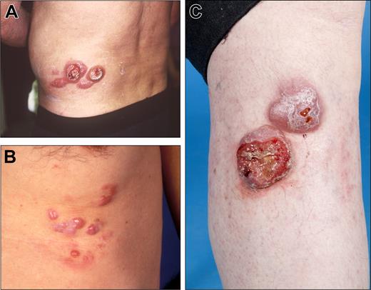 Figure 3. Clinical examples of proposed T2a (regional involvement with lesions within a 15 cm diameter area) category of primary cutaneous lymphomas. (A) CD30 + anaplastic large cell lymphoma. (B) Follicle center lymphoma. (C) Diffuse large B-cell lymphoma, leg-type.