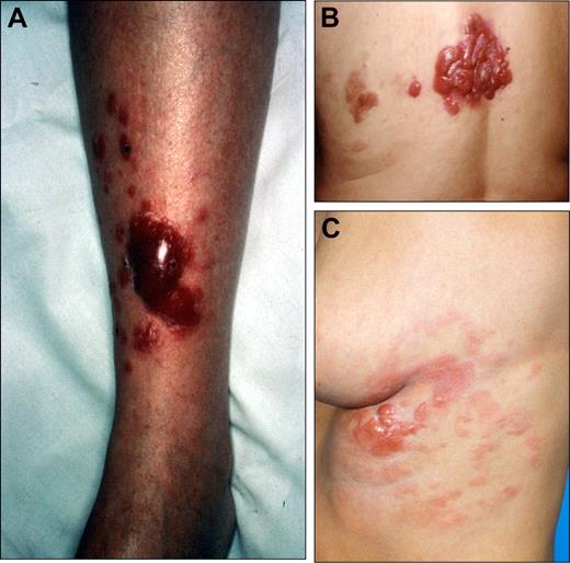Figure 4. Clinical examples of proposed T2b (regional involvement with lesions in an area between 15 cm and 30 cm diameter) category of primary cutaneous lymphomas. (A) diffuse large B-cell lymphoma, leg-type. (B) Follicle center lymphoma. (C) Follicle center lymphoma.