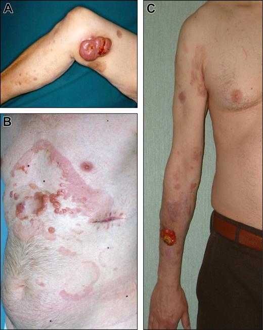 Figure 5. Clinical examples of proposed T2c (regional involvement with lesions more than 30 cm in diameter) category of cutaneous lymphomas. (A) Diffuse large B-cell lymphoma, leg-type. (B) Follicle center lymphoma. (C) Diffuse large B-cell lymphoma, leg-type.