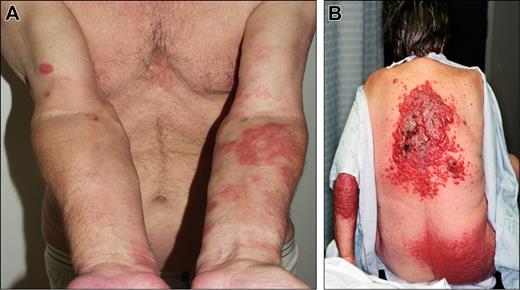 Figure 6. Clinical examples of proposed T3 (generalized) category of cutaneous lymphomas. (A) T3a (multiple lesions involving 2 noncontiguous body regions), follicle center lymphoma. (B) T3b (multiple lesions involving 3 or more body regions), CD30 + anaplastic large-cell lymphoma.
