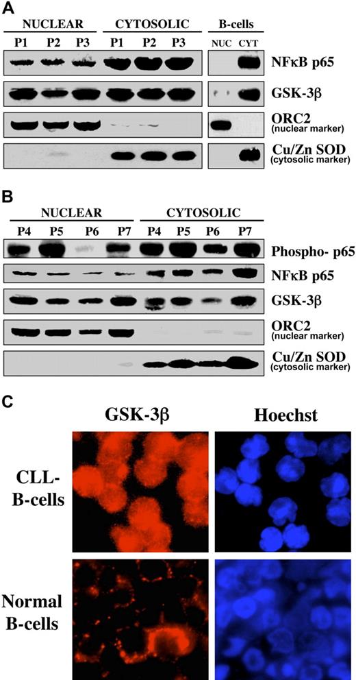 Figure 1. GSK-3β accumulates in the nucleus of CLL B cells. (A) Equivalent amounts (50 μg) of nuclear and cytosolic proteins isolated from the indicated sample from patients with CLL and from normal human B cells were separated by SDS-PAGE, immunoblotted, and probed with antibodies to the indicated proteins. P = patient. Cu/Zn super oxide dismutase (Cu/Zn SOD) and ORC2 are used as markers for the purity of the cytoplasmic and nuclear proteins, respectively. (B) Nuclear/cytosolic fractions were prepared from the indicated samples from patients with CLL, and protein expression was analyzed as described in panel A. (C) Immunofluorescence staining of GSK-3β (probed with TRITC-labeled anti-mouse secondary antibody, red fluorescence) in CLL B cells (top) and normal human B cells (bottom). Nuclei were counterstained with Hoechst 33342 (blue fluorescence).