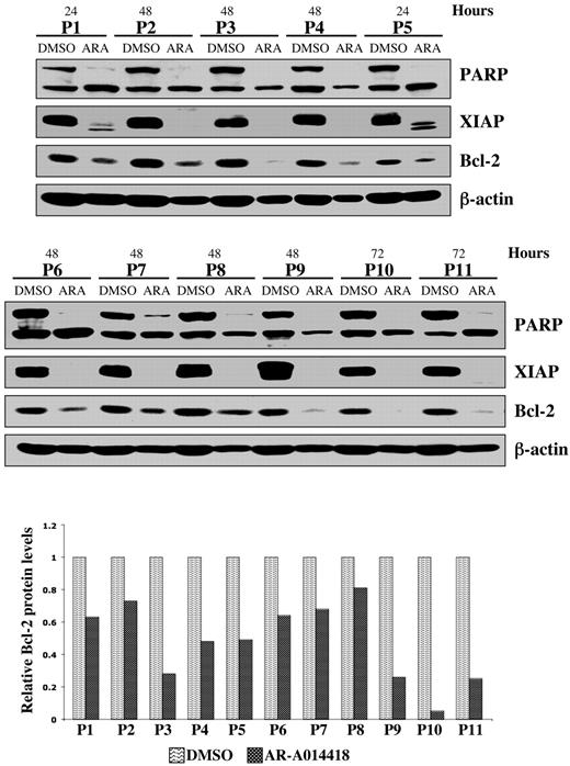 Figure 3. Pharmacologic inhibition of GSK-3 decreases NFκB-mediated survival of CLL cells. Malignant B cells from 11 patients with CLL were treated with diluent (DMSO) or 25 μmol/L AR-A014418; at the indicated time after treatment, the cell pellet was collected and protein was obtained. Cell lysates were separated by SDS-PAGE, transferred to PVDF membrane, and immunoblotted with the indicated antibodies. Western blot band intensities were quantified by using the Image J software (National Institutes of Health). The quantitative analysis of Bcl-2 protein levels (normalized to β-actin levels in each case) in DMSO versus AR-A014418–treated CLL B cells obtained from 11 patients with CLL are presented in the lower panel. ARA indicates AR-A014418; P, patient.