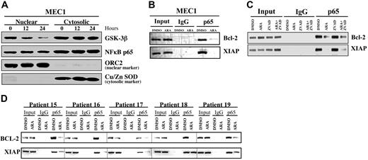 Figure 5. Inhibition of GSK-3 affects the binding of NFκB p65 to its target gene promoters in CLL cells. (A) MEC1 cells were treated with 25 μmol/L AR-A014418 for 0, 12, and 24 hours, as indicated. Nuclear/cytosolic fractions were prepared, and 50 μg of nuclear and cytosolic proteins were separated by SDS-PAGE, transferred to PVDF membrane, and immunoblotted as indicated. (B-C) Binding of NFκB p65 to the promoters of its target genes XIAP and Bcl-2 was assayed with the use of chromatin immunoprecipitation (ChIP) in MEC1 CLL cells treated with 25 μmol/L AR-A014418 (ARA), 50 μmol/L Z-VAD-FMK, or AR-A014418 + Z-VAD-FMK for 12 hours. (D) Immunoprecipitated chromatin was analyzed by PCR for the binding of NFκB p65 to the promoters of its target genes XIAP and Bcl-2 in malignant B cells from 5 patients with CLL treated with 25 μmol/L AR-A014418 (ARA) for 12 hours.