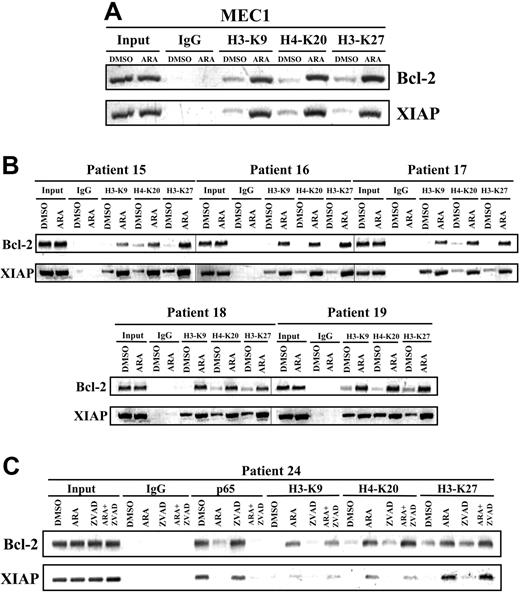 Figure 6. Inhibition of GSK-3 affects histone modification in CLL cells. (A-B) Twelve hours after treatment, genomic chromatin fragments from DMSO or 25 μmol/L AR-A014418 (ARA)-treated MEC1 cells (panel A) and malignant B cells from 5 patients with CLL (panel B) were immunoprecipitated with dimethyl-H3-K9, trimethyl-H3-K27, and dimethyl-H4-K20 antibodies. Immunoprecipitated chromatin was analyzed by PCR for the methylation of H3-K9, H3-K27, and H4-K20 at the XIAP and Bcl-2 promoters. PCR analysis on input chromatin (first 2 lanes) confirmed that equal chromatin amounts were used for ChIP. (C) Binding of NFκB p65 to the promoters of its target genes XIAP, and Bcl-2 was assayed in malignant B cells from a CLL patient treated with 25 μmol/L AR-A014418 (ARA) or 50 μmol/L Z-VAD-FMK (ZVAD) or AR-A014418 + Z-VAD-FMK for 12 hours by ChIP. Immunoprecipitated chromatin was also analyzed for the methylation of H3-K9, H3-K27, and H4-K20 at the XIAP and Bcl-2 promoters as described in (panels A and B).