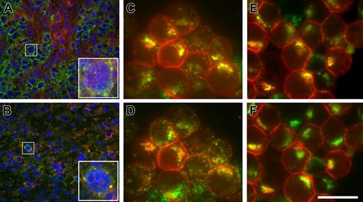 Figure 5. Anti-CD79b antibodies are targeted to the MIIC. Binding and internalization of anti-CD79b antibodies and ADCs in vivo and in vitro. BJAB-luc xenografts were treated with a control mouse anti-gp120-MCC-DM1 conjugate (A) or anti-CD79b(SN8)-MCC-DM1 conjugate (B). Frozen tissue sections were stained with antibodies to human IgM (green) and murine IgG (red); nuclei were counterstained with DAPI (blue). In control-treated xenografts (A), BJAB-luc cells show membrane staining for hIgM; mIgG was clearly detected within the tumor but was not colocalized with hIgM (inset). By contrast, in tumors treated with anti-CD79b(SN8)-MCC-DM1 (B), very few cells were positive for IgM; those that were positive showed colocalization of IgM and the murine IgG in a punctate pattern, consistent with the internalization of the ADC conjugate in these cells (inset). Note the reduced and pyknotic DAPI staining compared with panel A, caused by ADC-mediated cell killing. (C and D) In vitro, Ramos cells were allowed to internalize anti-CD79b(SN8) antibody and Alexa647-transferrin for 3 hours at 37°C in the presence of lysosomal protease inhibitors, then fixed, permeabilized, and stained with Cy3-conjugated anti-mouse antibody. Uptaken anti-CD79b(SN8) (red channel in panels C and D) is efficiently delivered to lysosomes, as shown by its extensive colocalization (yellow color) with the lysosomal marker anti-LAMP1 (Alexa488-labeled, green channel in panel C). There is much less yellow overlap with Alexa647-transferrin (shown in the green channel in panel D for ease of comparison with panel C). (E,F) Cells were labeled as in panels C and D, respectively, except 20 μg/mL brefeldin A was added during the last 15 minutes of uptake to further distinguish recycling endosomes from lysosomes, confirming that uptaken anti-CD79b(SN8) is delivered to lysosomes. The image shown is representative of 7 independent experiments. Scale bar = 20 μm in panels C-E and insets in panels A-B, and 100 μm in main panels A-B.