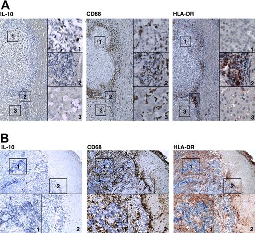 Figure 3. Distinct activation patterns of Mφ in tumor samples. Adjacent sections of paraffin-embedded hepatocellular (A) or nasopharyngeal (B) carcinoma were stained with an anti-CD68, anti-HLA-DR, or anti-IL-10 Ab (magnification ×160 in panel A and ×100 in panel B). The micrographs at higher magnification show the stained cancer nest,1 peritumoral stroma,2 and adjacent normal tissue.3 IL-10–positive Mπ are seen in the cancer nest, and Mφ with high HLA-DR expression have accumulated in the immediate vicinities of the cancer nest in hepatocellular carcinoma in panel A. Slides were viewed with a Leica DM IRB inverted research microscope (Leica Microsystems, Wetzlar, Germany) using a HI PLAN CY lens at 10 ×/0.25 PH and 40 ×/0.65 PH2 0.17/, 0.36 and Klear Mount medium (GBI Inc, Mukilteo, WA). Images were acquired using a QImaging camera (Surrey, BC, Canada), model Retiga 4000RV Fast 1394 Mono Cooled, and were processed with Image-Pro Plus 5.0 (Media Cybernetics, Silver Spring, MD) and Adobe Photoshop 7.0 (Adobe Systems, San Jose, CA) software.