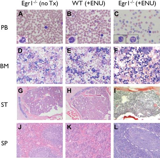 Figure 2. Histologic analysis of MPDs. (A-C) Peripheral blood (PB) smears stained with Wright-Giemsa; insets show high-magnification images of representative neutrophils. (D-F) Bone marrow (BM) aspirates stained with Wright-Giemsa. (G-I) Paraffin-embedded sections of sternum (ST) stained with H&E. (J-L) Paraffin-embedded sections of spleen (SP) stained with H&E. (L) Dashed outline encompasses pockets of immature and maturing myeloid elements. Images were obtained using an Olympus microscope (Model BX45, Tokyo, Japan) equipped with an Olympus DP12 digital camera (top row: 40× Plan Air objective/0.6NA (insets, 100× oil objective/1.26 NA), middle row: 10× Plan air objective/0.3 NA, bottom two rows: 4× Plan air objective/0.1NA), and processed using Microsoft PowerPoint (Redmond, WA).
