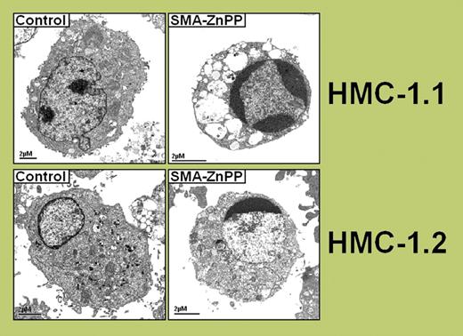 Effects of SMA-ZnPP (styrene maleic acid-micelle-encapsulated zinc-protopoaphyrin) on viability of neoplastic mast cells. HMC-1.1 cells and HMC-1.2 cells were cultured in control medium (left panels) or medium containing SMA-ZnPP (right panels) for 72 hours. Cells cultured in SMA-ZnPP showed signs clearly characteristic of apoptosis. See the complete figure in the article beginning on page 661.