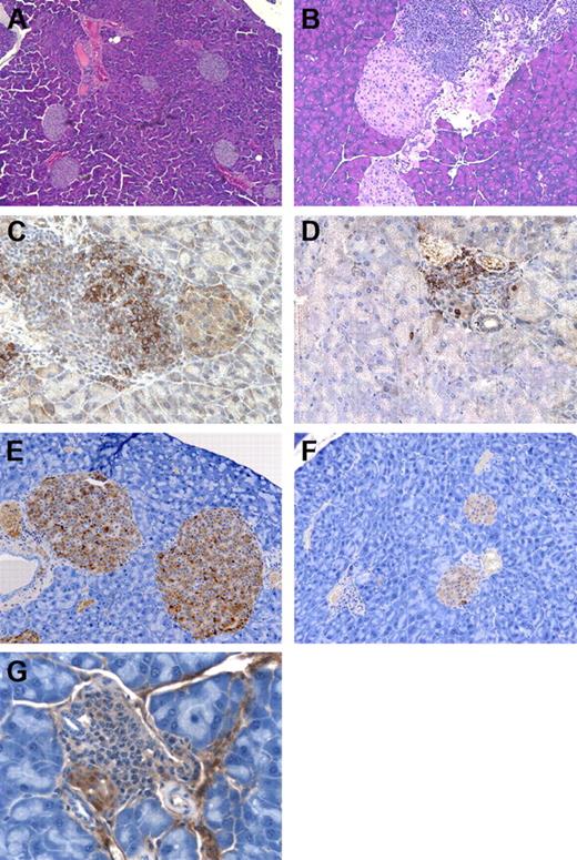 Figure 1. GM-CSF/IL-3–deficient mice develop insulitis. (A) Wild-type mouse with normal islets, original magnification × 100. (B) Insulitis and peri-insulitis in GM-CSF/IL-3–deficient mouse, original magnification × 200. (C) B220+ B cells in the islets of GM-CSF/IL-3–deficient mouse, original magnification × 400. (D) CD3+ T cells in the islets of GM-CSF/IL-3–deficient mouse, original magnification × 400. (E) Insulin-producing β cells in wild-type mouse, original magnification × 200. (F) Decreased insulin-producing β cells in GM-CSF/IL-3–deficient mouse, original magnification × 200. (G) Insulitis with β-cell destruction in GM-CSF/IL-3–deficient mouse, original magnification × 400.
