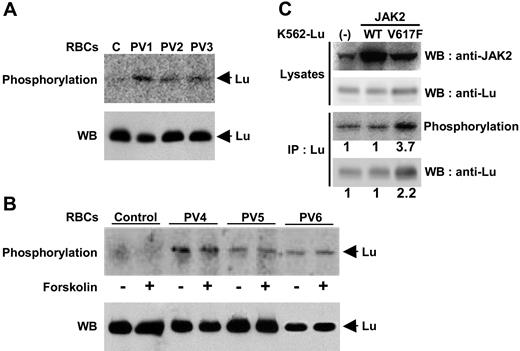 Figure 6. Phosphorylation of Lu/BCAM in RBCs and K562 cells. Normal or PV RBCs were incubated with 32P orthophosphate in the absence (A) or presence (B) of forskolin, and Lu/BCAM was immunoprecipitated using mAb against Lu/BCAM. After elution, SDS-PAGE, and transfer to nitrocellulose membrane, the phosphorylated proteins were detected using a PhosphorImager. As previously reported, no phosphorylation was detected in the normal RBCs, while in the 6 patients with PV, the Lu/BCAM long isoform was phosphorylated in the absence of any stimulation. Western blot (WB) using anti-Lu rabbit antibody 602 showed that equivalent amounts of Lu protein were immunoprecipitated for each patient in the absence or presence of forskolin in panel B. (C) Phosphorylation of recombinant Lu/BCAM gp in K562 cells. Recombinant JAK2 WT or 617V>F were transiently expressed in K562-Lu/BCAM cells and detected by Western blot (WB; top row). Expression of recombinant Lu/BCAM was tested in cell lysates by Western blot (second row). Phosphorylation of Lu/BCAMgp was analyzed after immunoprecipitation (IP; third panel), and total immunoprecipitated Lu/BCAM proteins were revealed by Western blot (bottom row). Results are representative of 3 independent experiments. The phosphorylation in K562 cells tranfected with 617V>F was 3.7-fold (± 1.1-fold) higher, while Lu/BCAM protein was doubled (2.2-fold ± 0.3-fold) compared with K562 cells transfected with WT JAK2.